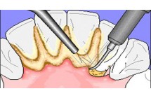 Quy Trình Cạo Vôi Răng Đạt Chuẩn Hiện Nay